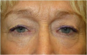 older woman eyes before