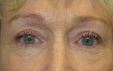 older woman after