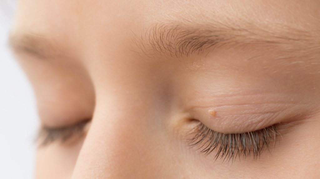 Eyelid growths on a woman's face