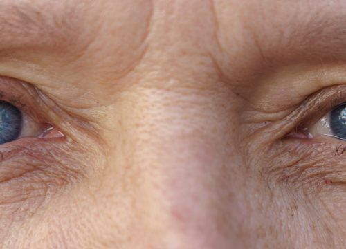 Close-up on a woman's eyes after ptosis repair