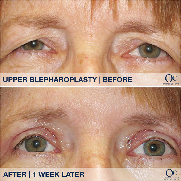 Before and after eyelid lift surgery results