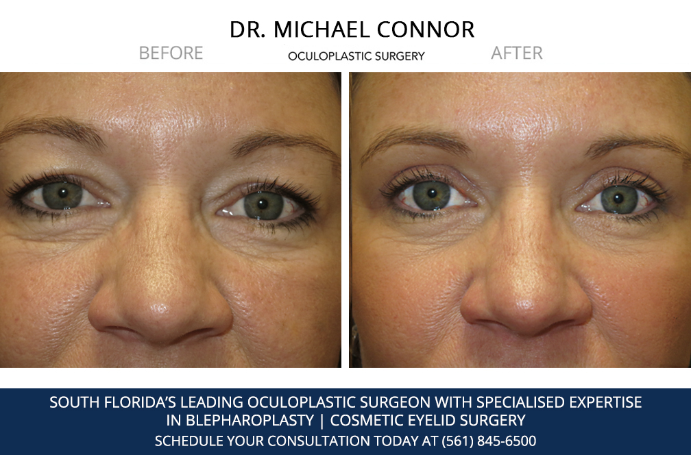 Before and after blepharoplasty results
