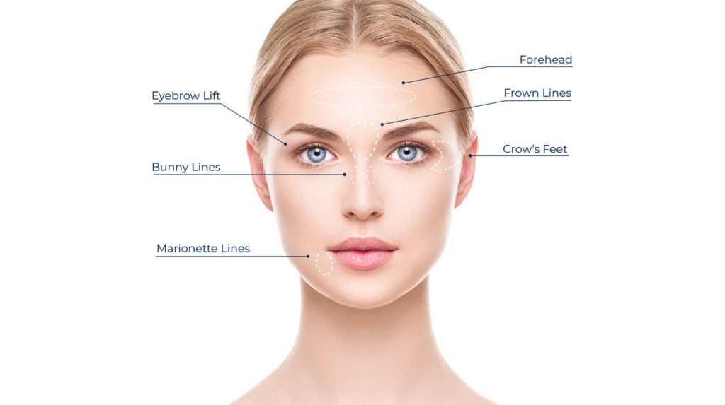 BOTOX Cosmetic treatment areas