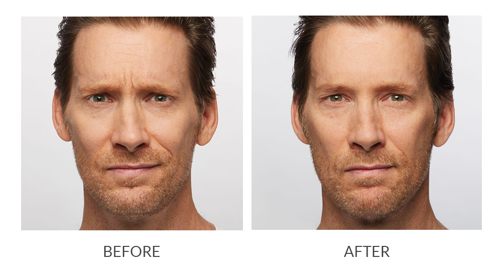 Before and after photos of a man who received Botox