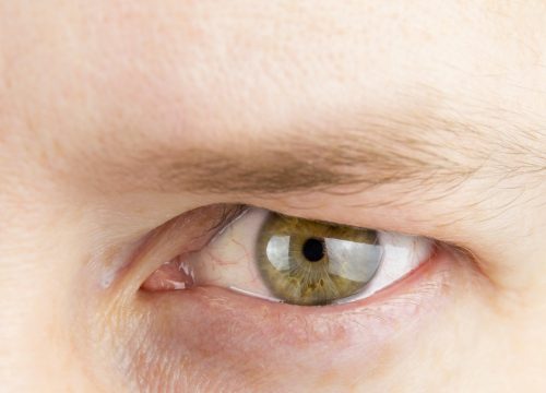 Close-up on a man who received a brow lift
